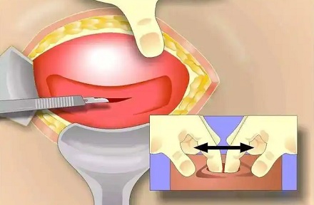 为啥剖腹产要用手撕成大口，而不是用刀切开？