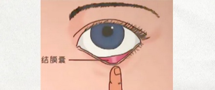 为什么有的人揉眼睛时,眼睛会发出咯吱咯吱的响声?
