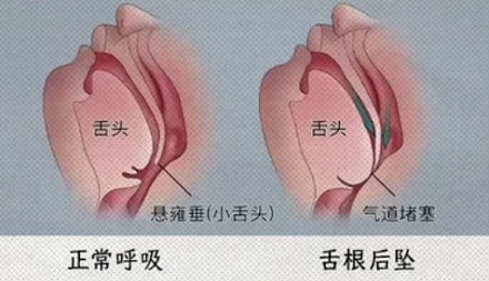 为什么手术结束后,不能随便睡觉?