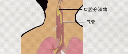 为什么手术结束后,不能随便睡觉?