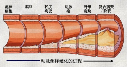 为什么心梗大都发生在清晨?