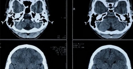 为什么拍了片子还要做 CT,做了 CT 又要上核磁共振?