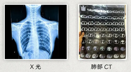 为什么拍了片子还要做 CT,做了 CT 又要上核磁共振?