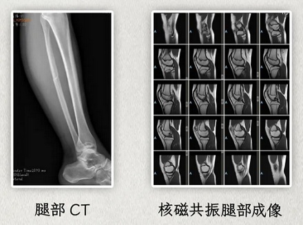 为什么拍了片子还要做 CT,做了 CT 又要上核磁共振?