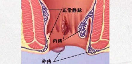 妖怪吃了唐僧的痔疮，能长生不老吗？
