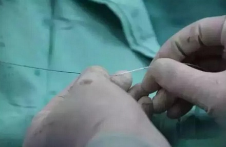 明明是做心脏支架手术，为什么却要在手腕上开一刀？