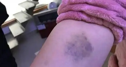 身上的淤青变成黄色，是快痊愈了还是更严重了？